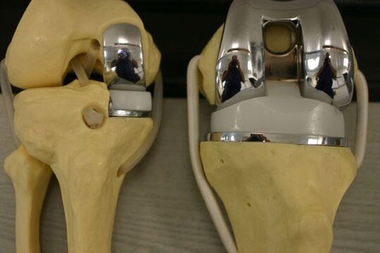 Variantes de endoprotética de la articulación de la rodilla