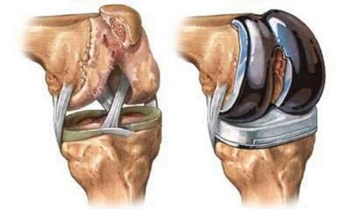 Endoprotética de la articulación de la rodilla para la artrosis