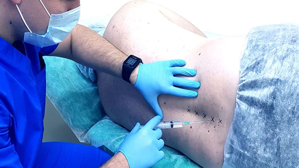 Bloqueo espinal para la osteocondrosis