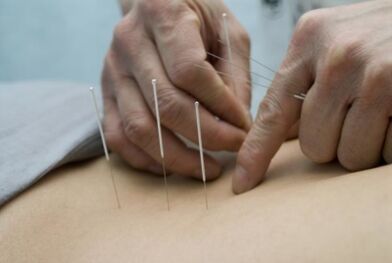 Acupuntura para la osteocondrosis de la región torácica.