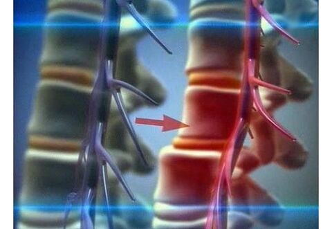 Compresión de terminaciones nerviosas en la osteocondrosis lumbar.