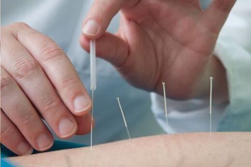 La acupuntura es un método para tratar el dolor en la región lumbar causado por la osteocondrosis.
