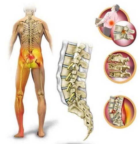Osteocondrosis de la columna lumbar, que causa dolor lumbar.