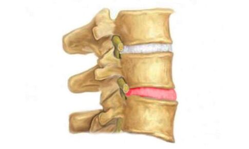 Protrusión del disco intervertebral de la columna vertebral un signo de osteocondrosis