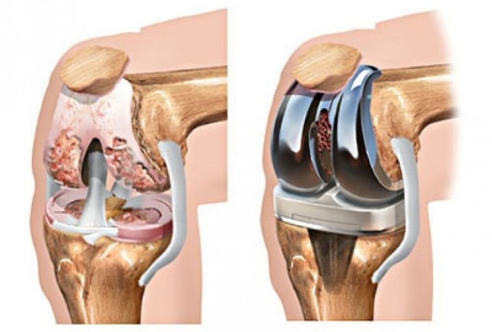 artroplastia de rodilla por artrosis