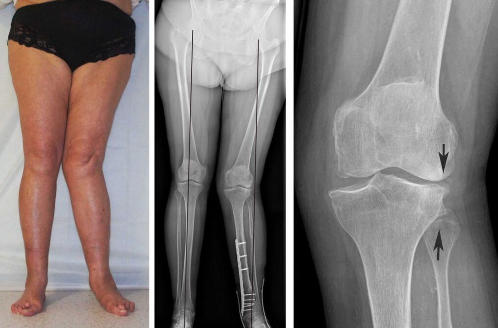 cuadro clínico de artrosis de rodilla