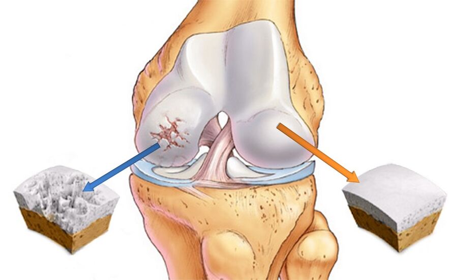 Articulación de rodilla sana (derecha) y afectada por artrosis (izquierda)