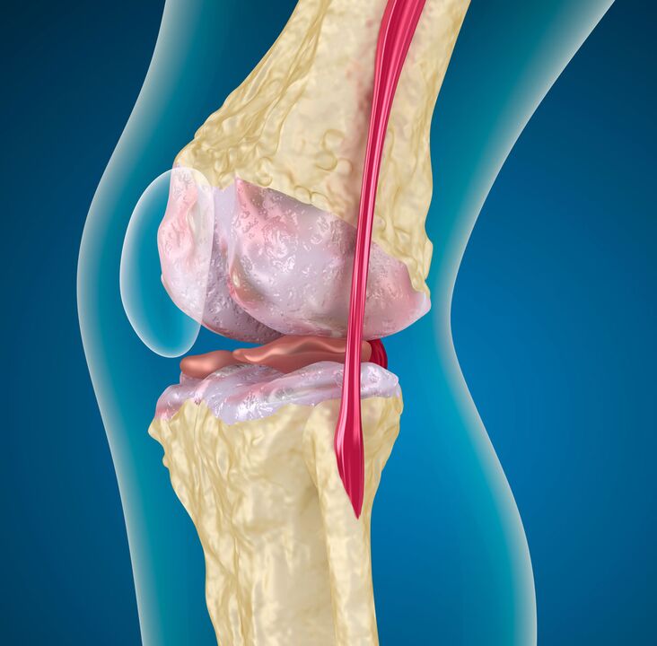 Artrosis de la articulación de la rodilla una enfermedad distrófica degenerativa