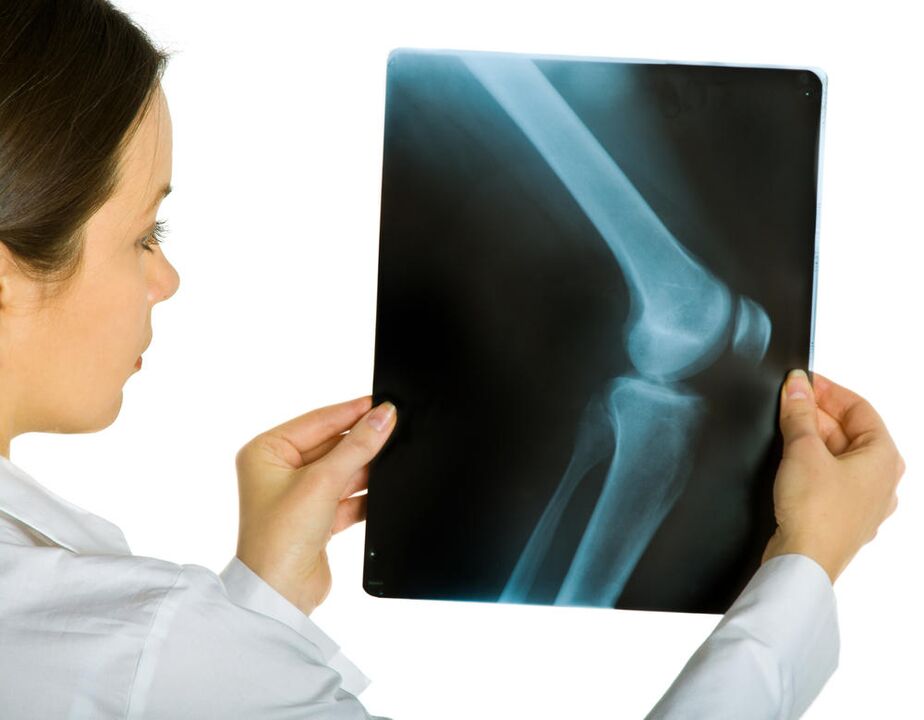 La radiografía de la articulación de la rodilla revelará la presencia de artrosis deformante. 
